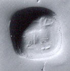 X-ray View of Decayed Tooth
