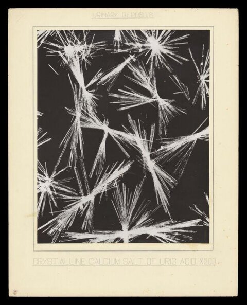 Magnified Uric Acid Calcium Salt Crystals